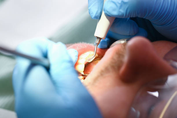 Best Emergency Tooth Extraction in Ingleside, TX