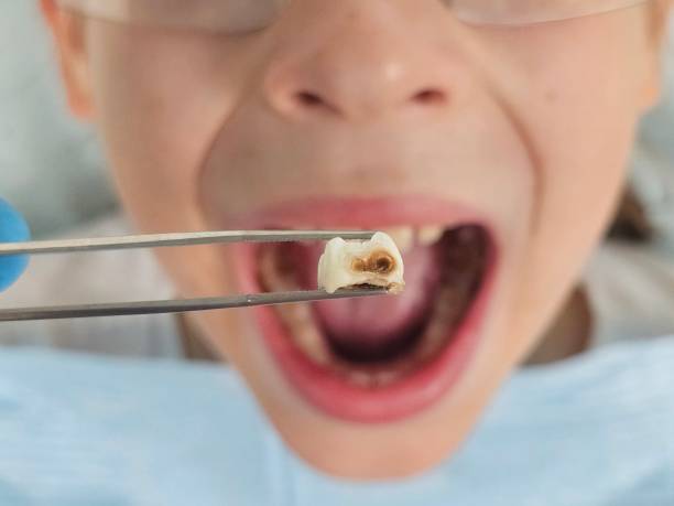 Best Same-Day Emergency Dentist in Ingleside, TX